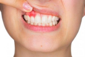 Endodoncia Avanzada Infecciones Dentales