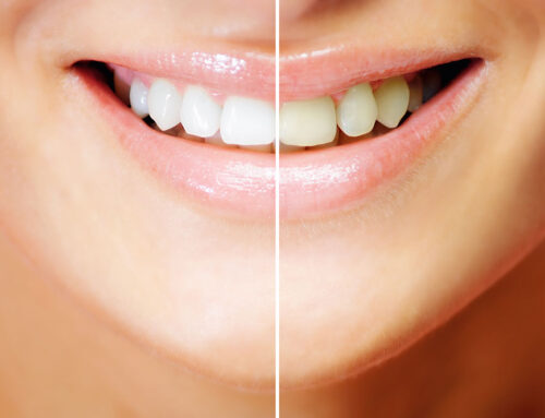 Blanqueamiento Dental: lo que debes saber