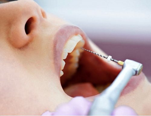 Endodoncia En Una Sesión