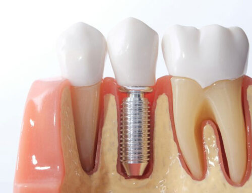 Implantes Dentales