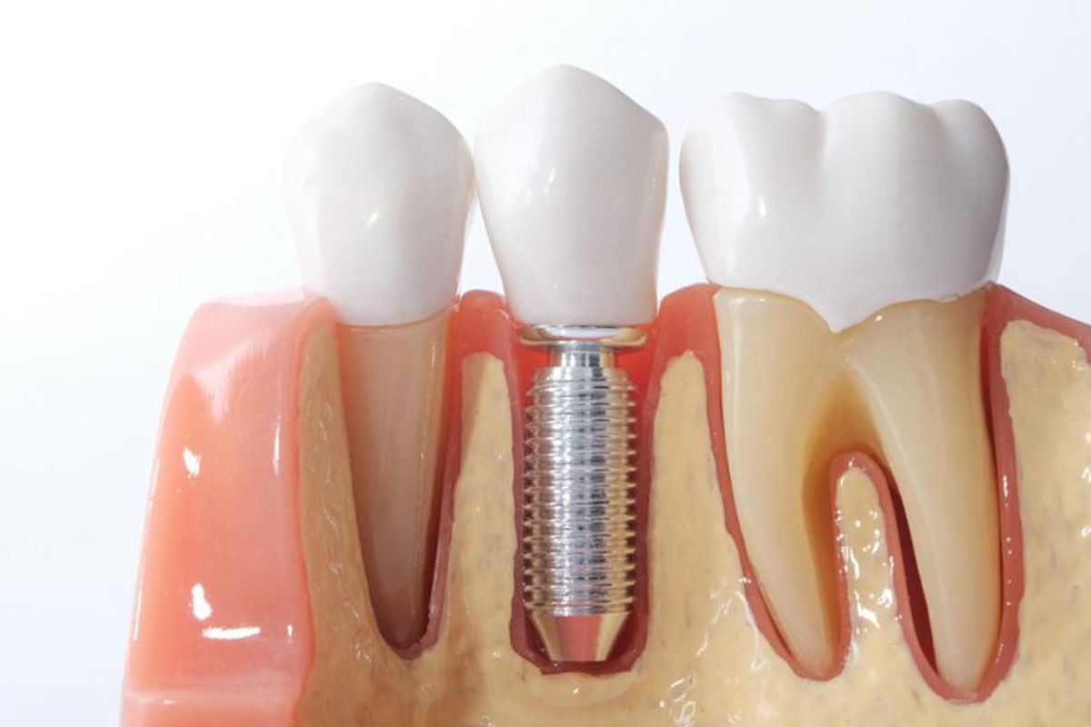 Implantes Dentales EndoAvanzada