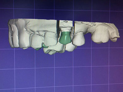 Rehabilitación Dental Diseño protesis 3 EndoAvanzada