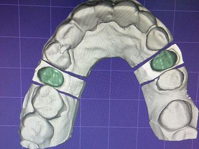 Rehabilitación Dental Diseño protesis EndoAvanzada