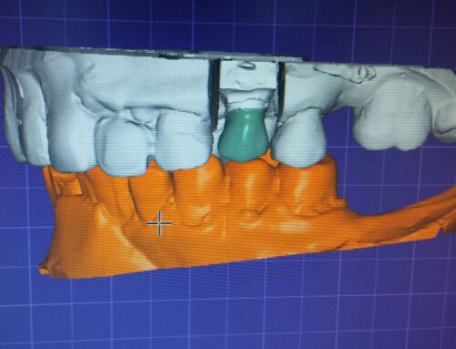 Rehabilitación Dental Post Endodóntica con sistema CAD-CAM