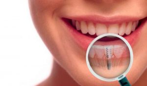 Implantes Dentales en Salamanca