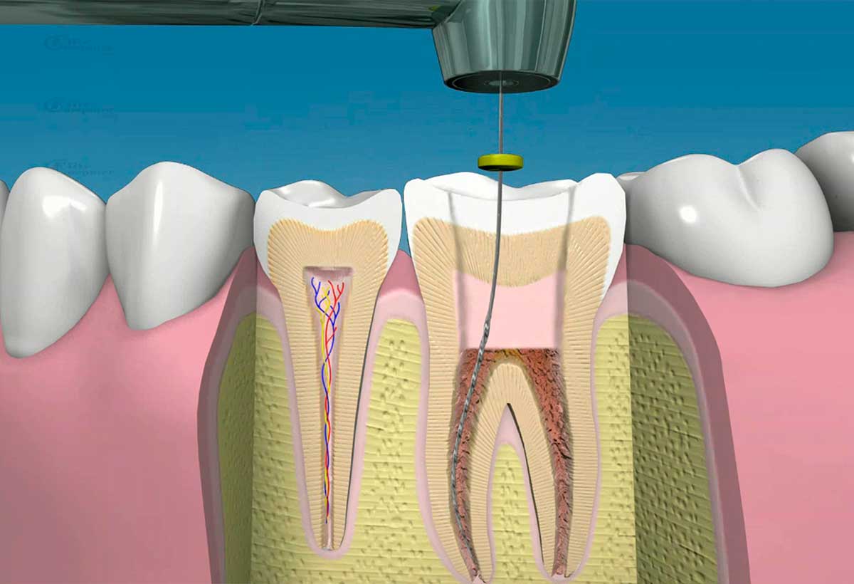 Retratamiento Endodontico